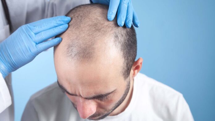 Best Hair Transplant in Chandigarh